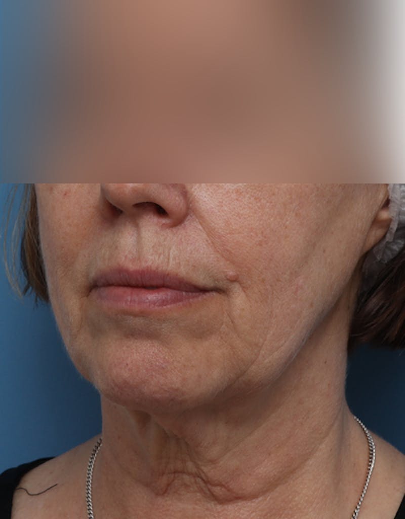 Facelift Before & After Gallery - Patient 319593 - Image 5