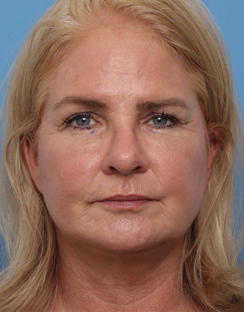 Facelift Before & After Gallery - Patient 217063 - Image 8
