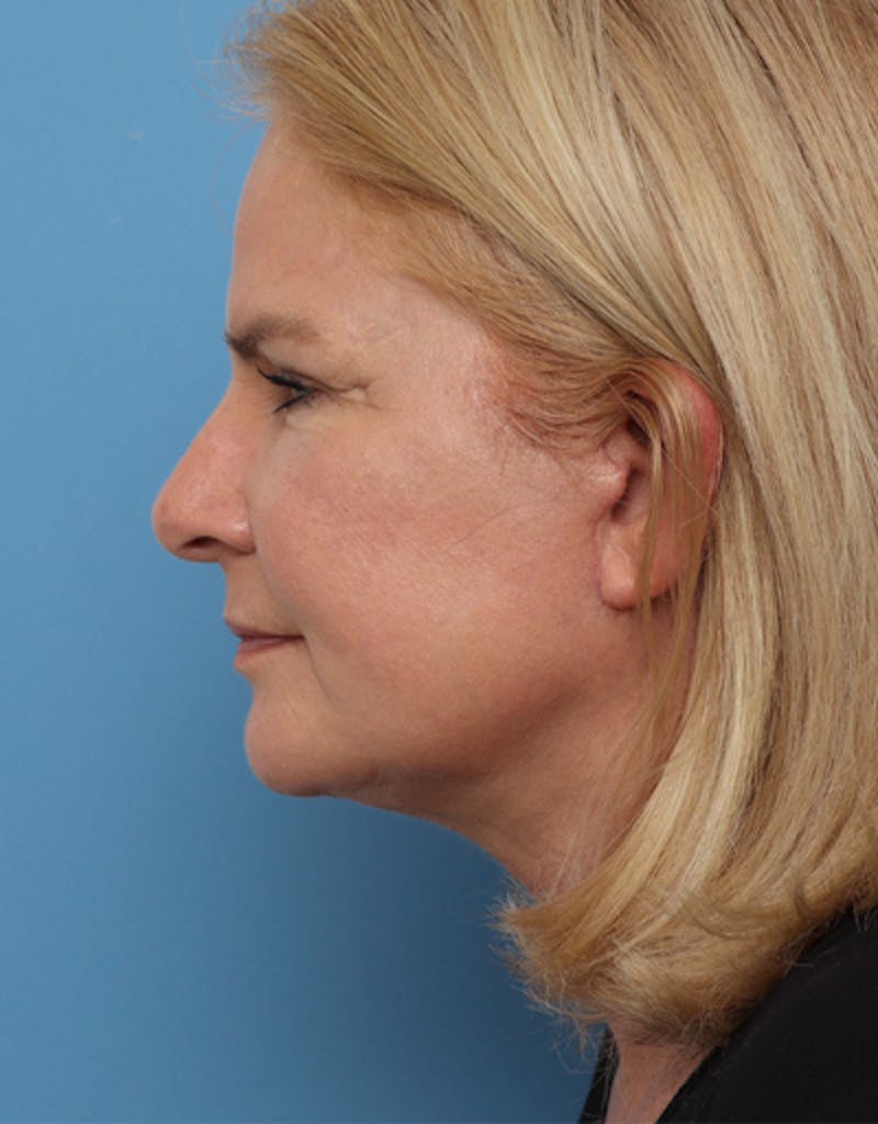 Facelift Before & After Gallery - Patient 217063 - Image 6