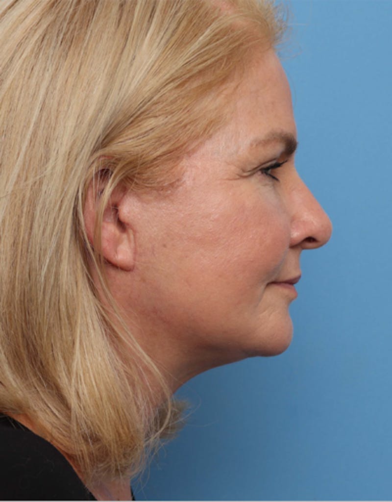 Facelift Before & After Gallery - Patient 217063 - Image 4