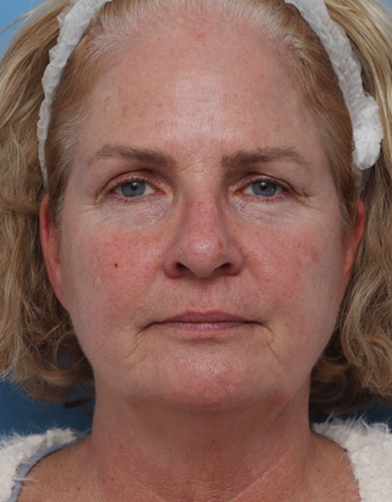 Facelift Before & After Gallery - Patient 217063 - Image 7