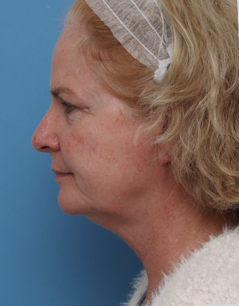 Facelift Before & After Gallery - Patient 217063 - Image 5