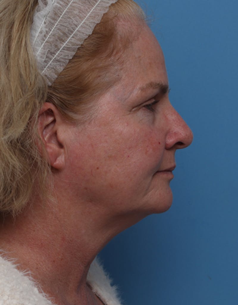 Facelift Before & After Gallery - Patient 217063 - Image 3