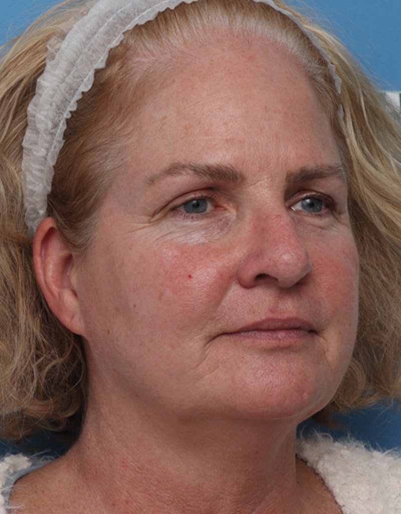 Patient Yv7mC_B_Q_6PBiTY6_giZA - Facelift Before & After Photos