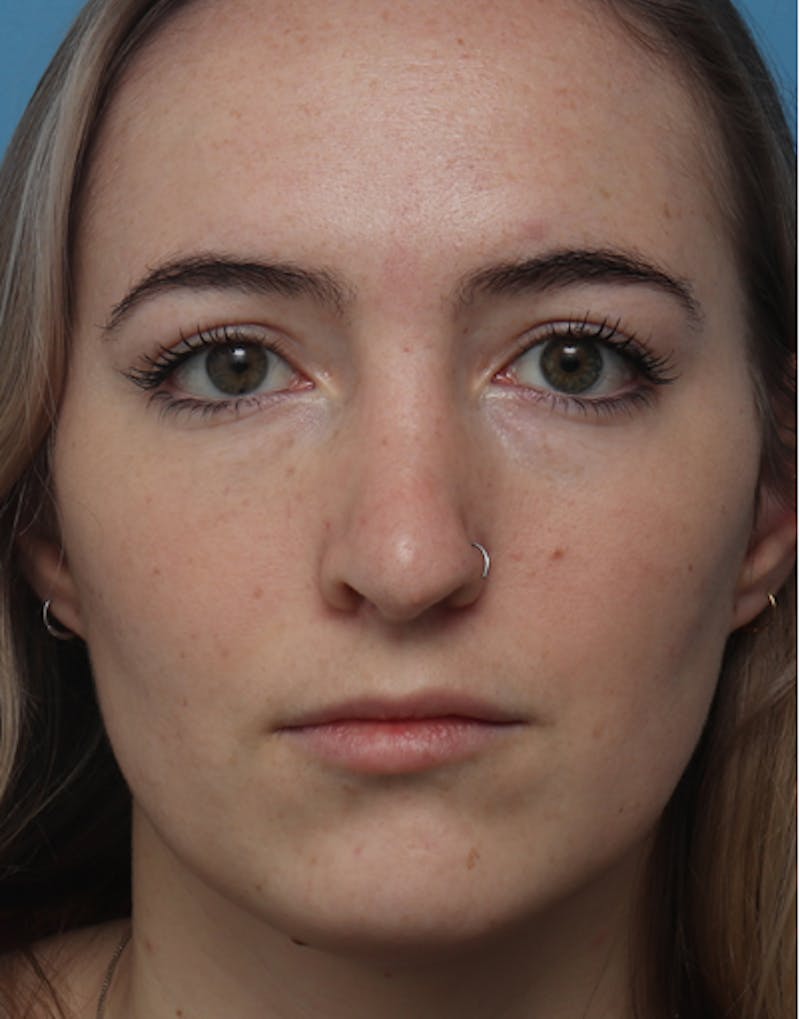 Patient fwF3d87jQSCuu9hjdCdxqg - Rhinoplasty Before & After Photos