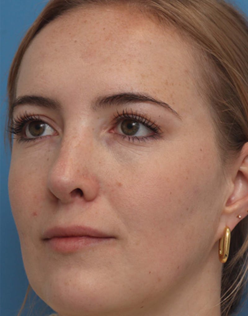 Rhinoplasty  Before & After Gallery - Patient 464379 - Image 6