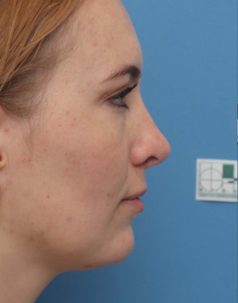 Rhinoplasty  Before & After Gallery - Patient 464379 - Image 4