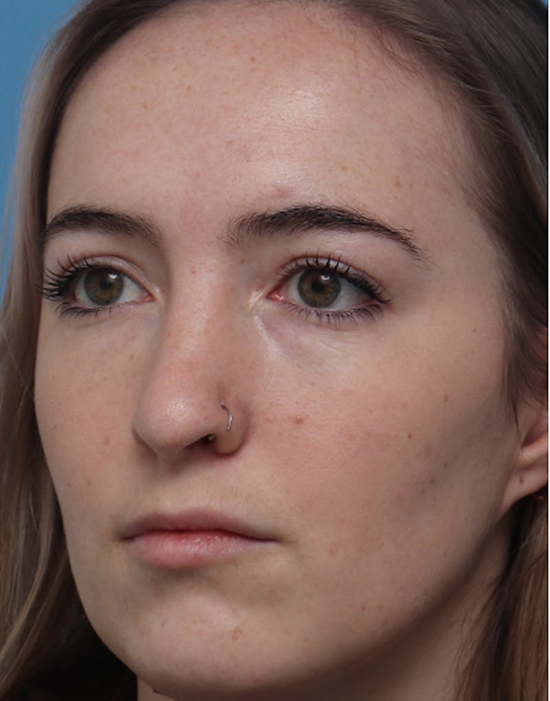 Rhinoplasty  Before & After Gallery - Patient 464379 - Image 5