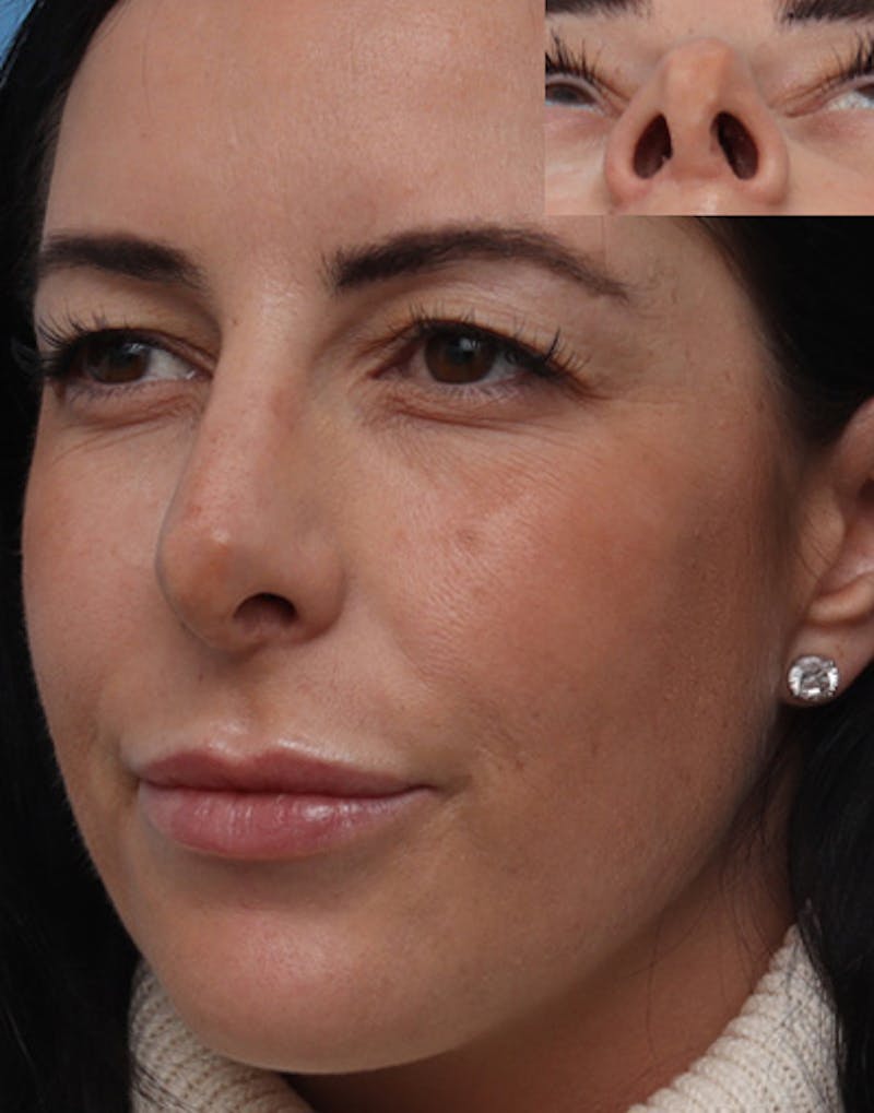 Rhinoplasty  Before & After Gallery - Patient 344380 - Image 7