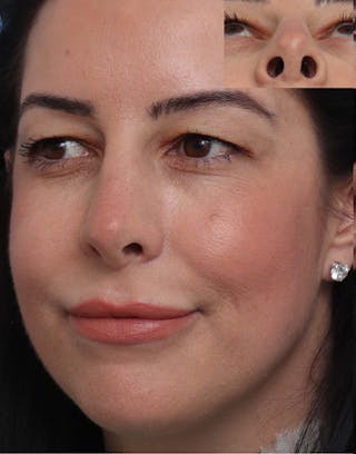 Rhinoplasty Before & After Gallery - Patient 344380 - Image 8