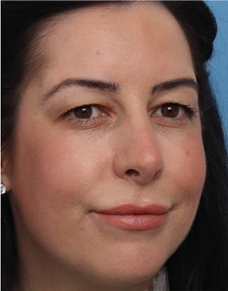 Rhinoplasty Before & After Gallery - Patient 344380 - Image 4