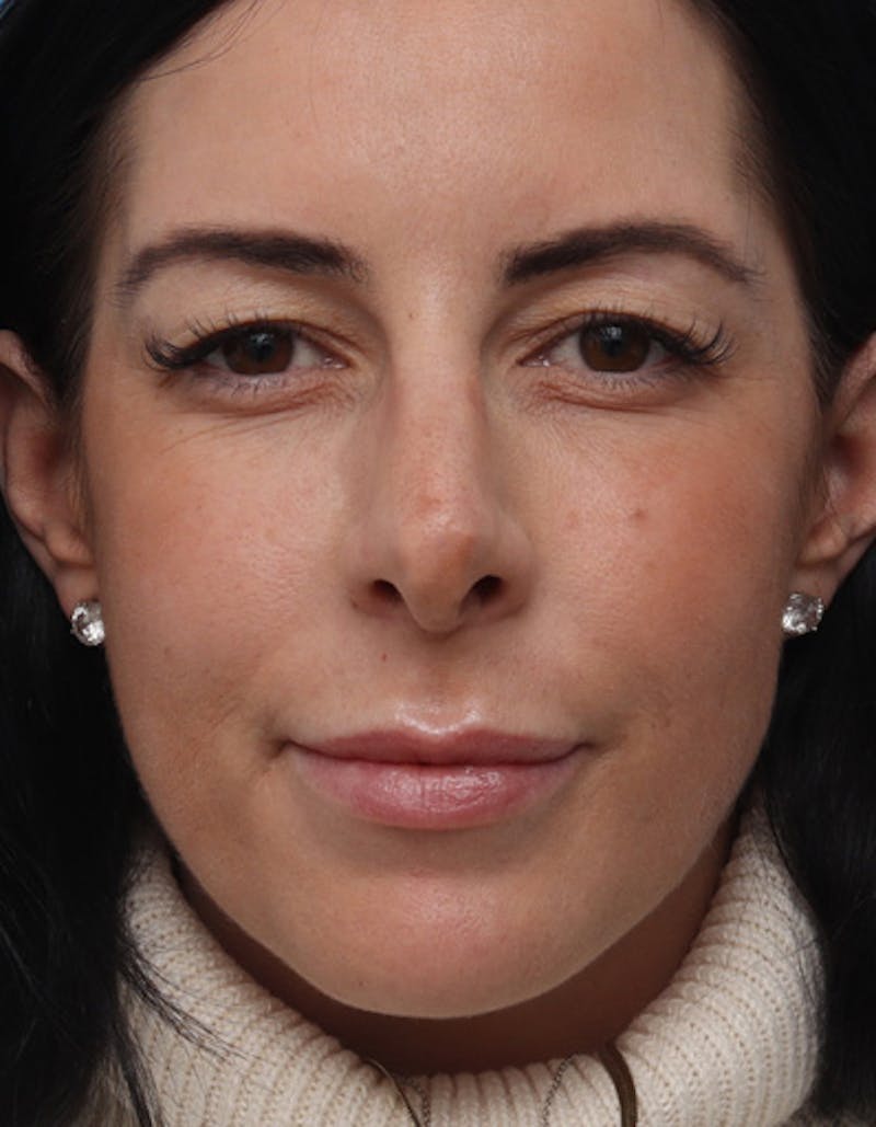 Rhinoplasty  Before & After Gallery - Patient 344380 - Image 5