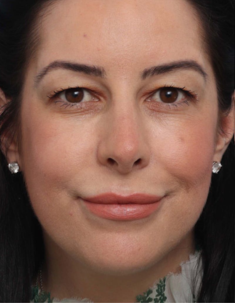 Rhinoplasty  Before & After Gallery - Patient 344380 - Image 6