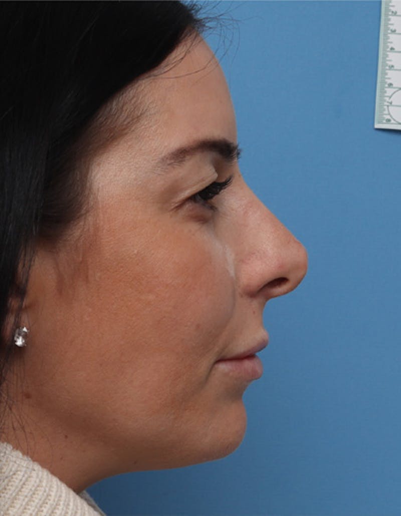 Patient EQjAG7bdRdm5qyKAXmoDwg - Revision Rhinoplasty Before & After Photos