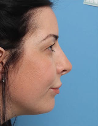 Rhinoplasty Before & After Gallery - Patient 344380 - Image 2