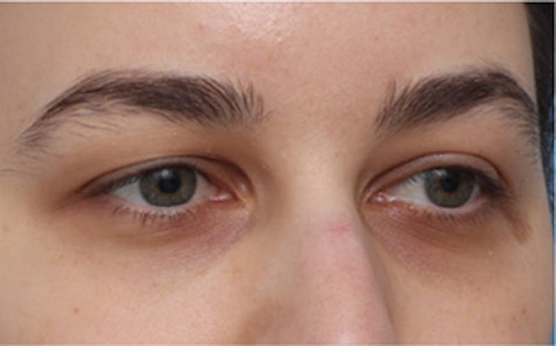 Eyelid Surgery Before & After Gallery - Patient 217505 - Image 3