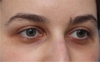 Eyelid Surgery Before & After Gallery - Patient 217505 - Image 4