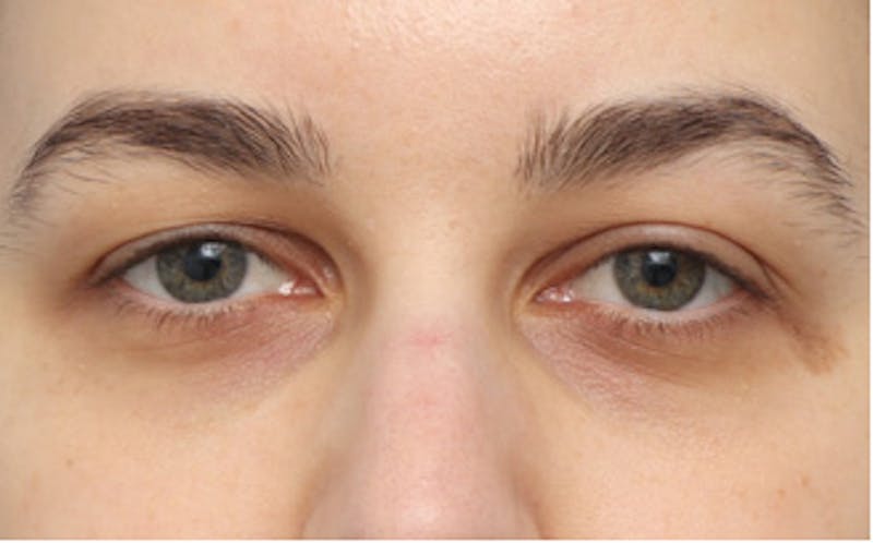 Eyelid Surgery Before & After Gallery - Patient 217505 - Image 1