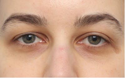 Eyelid Surgery Before & After Gallery - Patient 217505 - Image 1