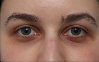 Eyelid Surgery Before & After Gallery - Patient 217505 - Image 2