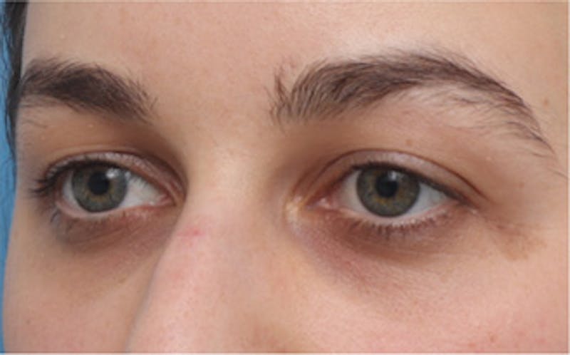 Eyelid Surgery Before & After Gallery - Patient 217505 - Image 5