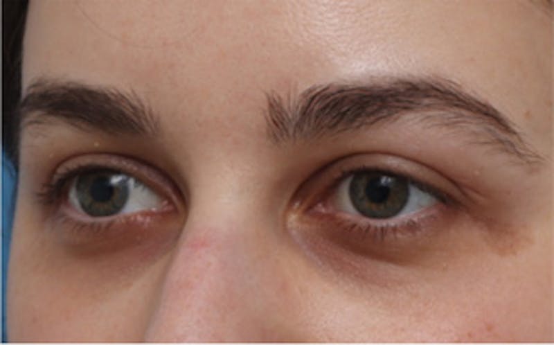 Eyelid Surgery Before & After Gallery - Patient 217505 - Image 6