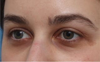 Eyelid Surgery Before & After Gallery - Patient 217505 - Image 6