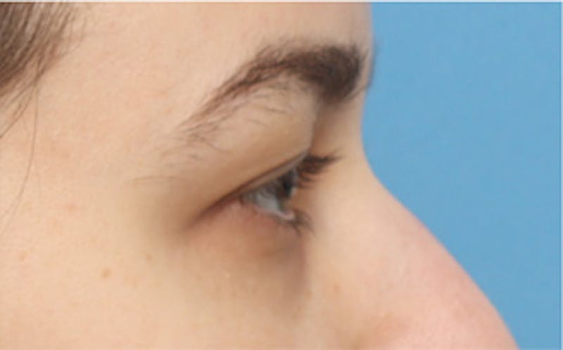 Eyelid Surgery Before & After Gallery - Patient 217505 - Image 7