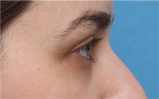 Eyelid Surgery Before & After Gallery - Patient 217505 - Image 8