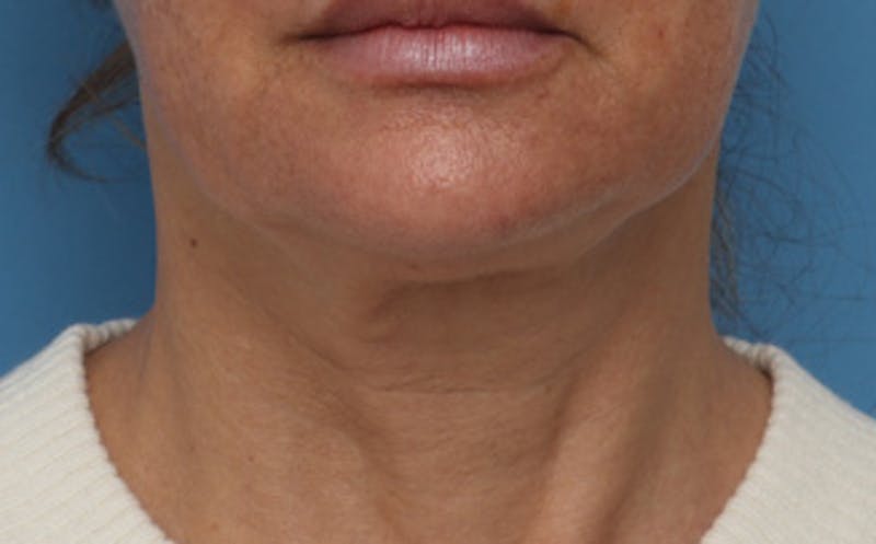 Patient LE_dQwVESnimPZb3Jnh34Q - FaceTite Before & After Photos