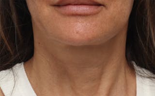 FaceTite Before & After Gallery - Patient 287292 - Image 2