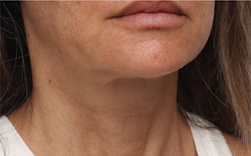 FaceTite Before & After Gallery - Patient 287292 - Image 4
