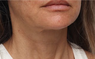 FaceTite Before & After Gallery - Patient 287292 - Image 4