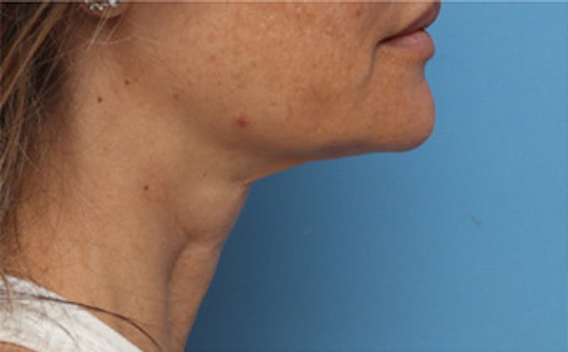 FaceTite Before & After Gallery - Patient 287292 - Image 6