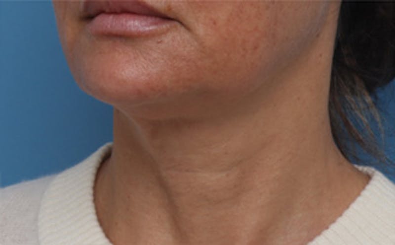 FaceTite Before & After Gallery - Patient 287292 - Image 7