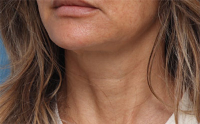 FaceTite Before & After Gallery - Patient 287292 - Image 8