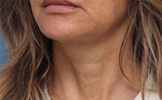 FaceTite Before & After Gallery - Patient 287292 - Image 8