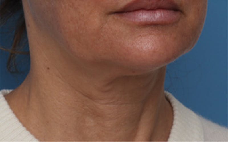 FaceTite Before & After Gallery - Patient 287292 - Image 3