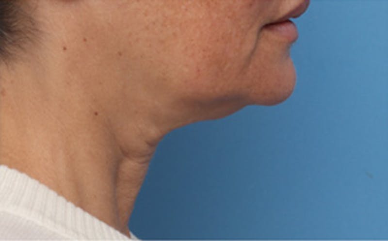 FaceTite Before & After Gallery - Patient 287292 - Image 5