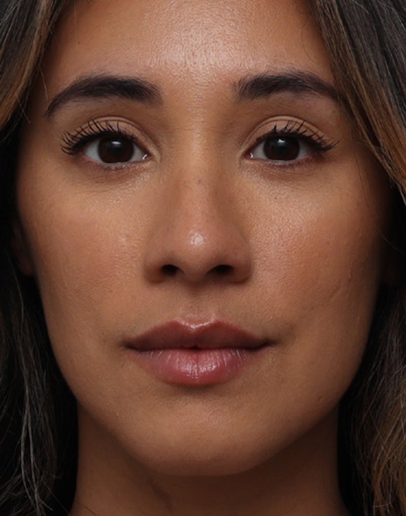 Rhinoplasty  Before & After Gallery - Patient 396256 - Image 3