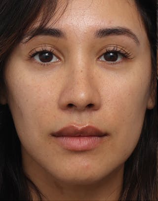 Rhinoplasty Before & After Gallery - Patient 396256 - Image 4