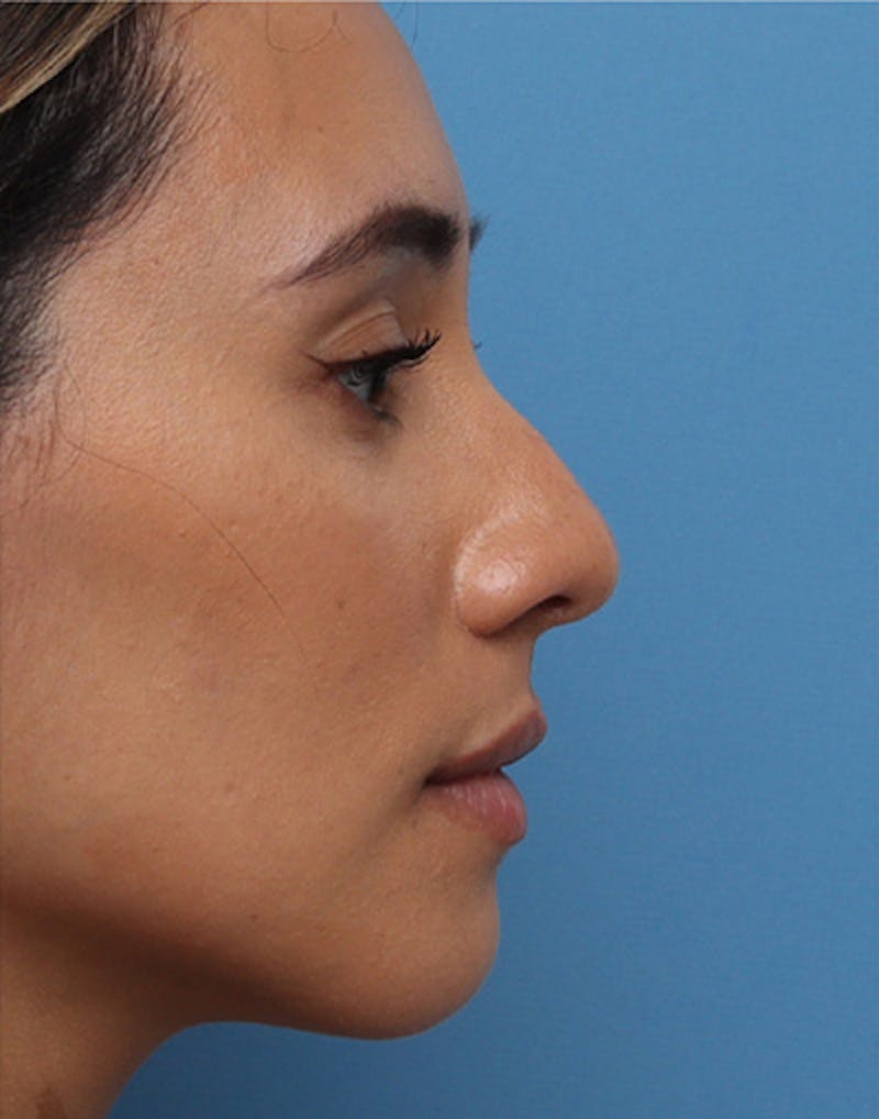 Patient WJCiedo6RkOHUCQqWd6ZDw - Rhinoplasty Before & After Photos