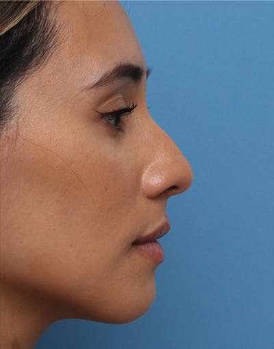 Rhinoplasty Before & After Gallery - Patient 396256 - Image 1