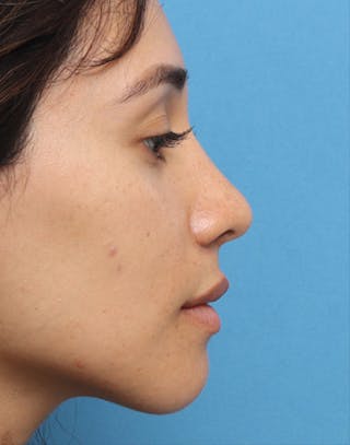 Rhinoplasty Before & After Gallery - Patient 396256 - Image 2