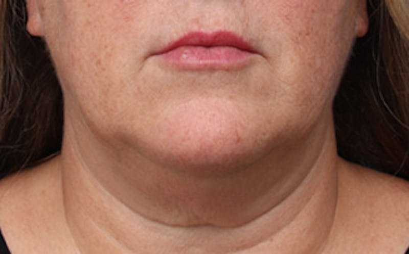 Patient R_XAVFl6RXqLaStA699SwA - FaceTite Before & After Photos