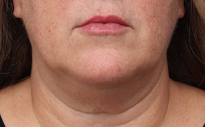 FaceTite Before & After Gallery - Patient 163386 - Image 1