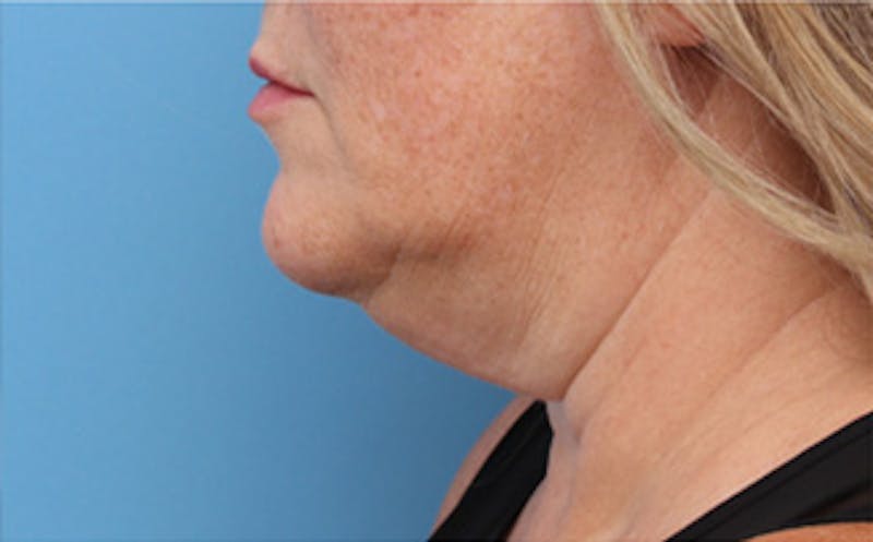 FaceTite Before & After Gallery - Patient 163386 - Image 5