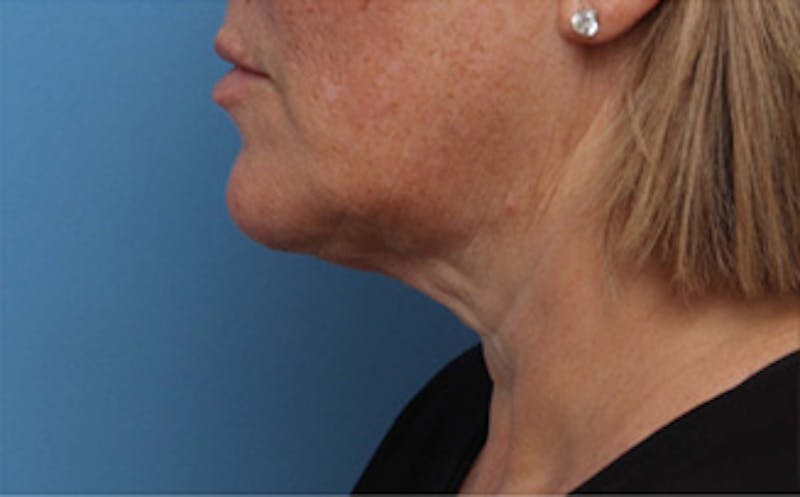 FaceTite Before & After Gallery - Patient 163386 - Image 6