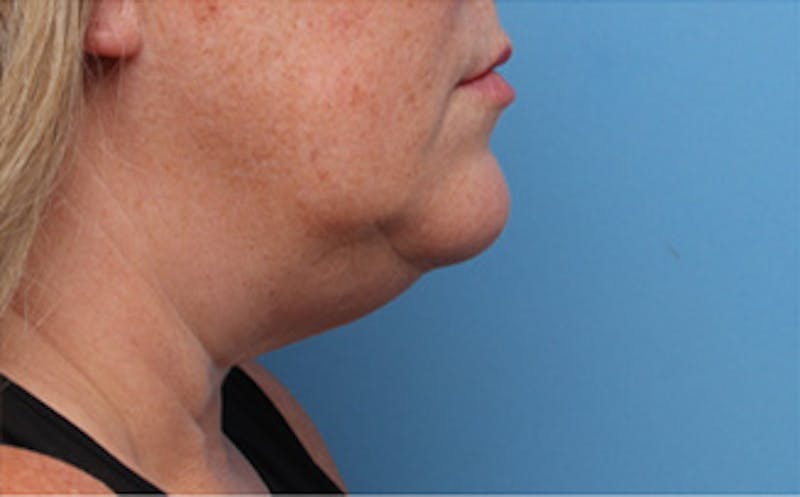FaceTite Before & After Gallery - Patient 163386 - Image 7