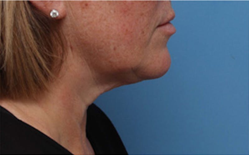 FaceTite Before & After Gallery - Patient 163386 - Image 8